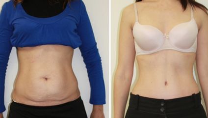 Antes y después de Abdominoplastia + Liposucción