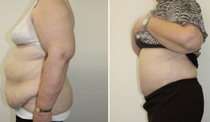 Antes y después de Abdominoplastia + Liposucción