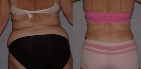 Antes y después de Liposucción + Abdominoplastia