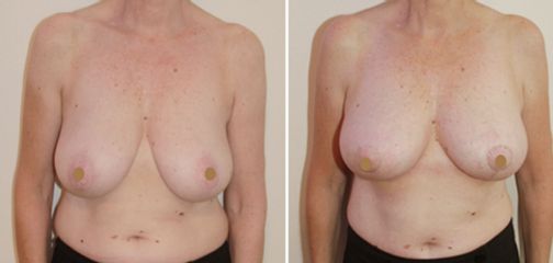 Antes y después de Mastopexia