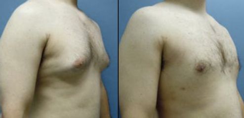 Antes y después de Ginecomastia