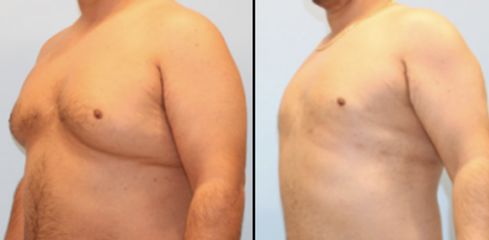 Antes y después de Ginecomastia