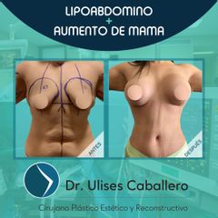 Lipoabdomindoplastia + Aumento de busto - Dr. Ulises Caballero de la Peña
