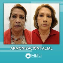 Armonización facial - MEILi - Rejuvenecimiento