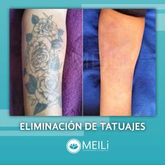 Eliminación de tatuajes - MEILi