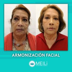 Armonización Facial - MEILi - Rejuvenecimiento