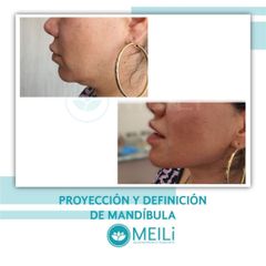 Proyección Mandibular - MEILi - Rejuvenecimiento