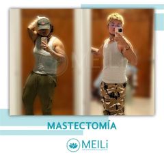 Mastectomia - MEILi -  Rejuvenecimiento