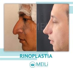 Rinoplastia - MEILi - Rejuvenecimiento