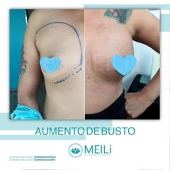 Aumento De Busto - MEILi - Rejuvenecimiento