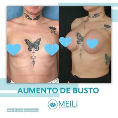 Aumento De Busto - MEILi -  Rejuvenecimiento