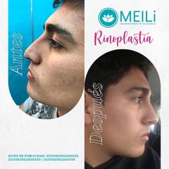 Rinoplastia - MEILi Rejuvenecimiento y Acupuntura