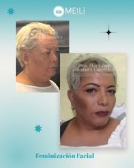 Feminización Facial - MEILi Rejuvenecimiento