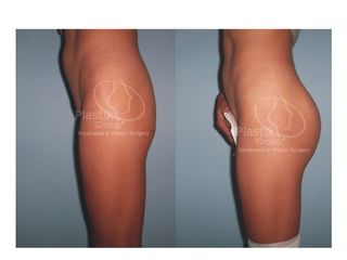 Antes y después de Gluteoplastia de aumento