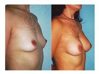 Antes y después de Mamoplastia