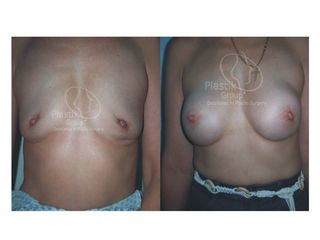 Antes y después de Aumento de labios