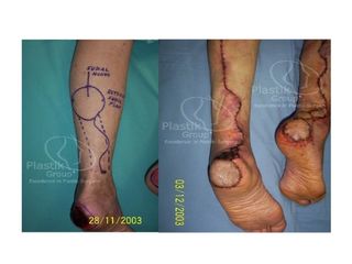 Antes y después de Úlceras de talón 