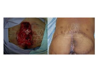 Antes y después de Úlcera presión sacra