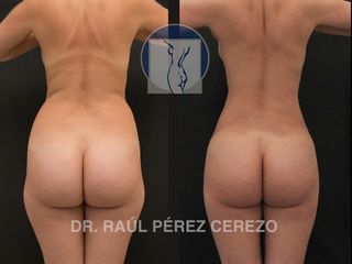 Antes y después de Liposucción