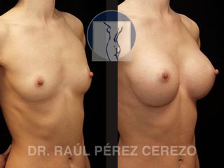 Antes y después de Aumento de busto