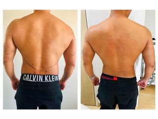 Antes y después de Lipoescultura