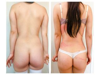 Antes y después de Liposucción