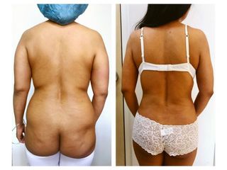 Antes y después de Cirugía para cicatrices