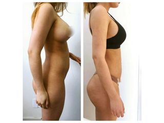 Antes y después de Liposucción