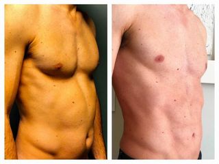 Antes y después de  Abdominoplastia