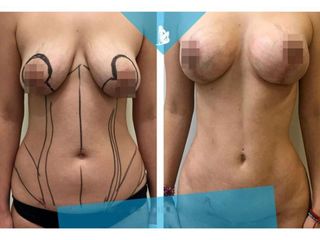 Lipoescultura - Dr. Christian Augusto Morales Orozco