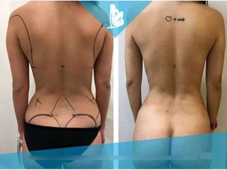 Lipoescultura - Dr. Christian Augusto Morales Orozco