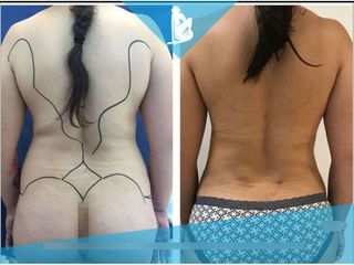 Liposucción - Dr. Christian Augusto Morales Orozco