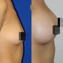 Aumento de busto - Dr. Christian Augusto Morales Orozco