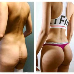 Gluteoplastia - Dr. Christian Augusto Morales Orozco