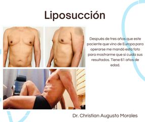 Liposucción - Dr. Christian Augusto Morales Orozco