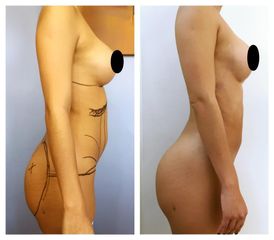 Lipoescultura - Dr. Christian Augusto Morales Orozco