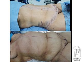 Abdominoplastia - Dr. Rodrigo Valero Jarillo