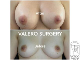 Aumento de busto - Dr. Rodrigo Valero Jarillo