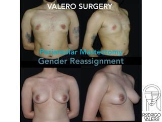 Mastopexia - Dr. Rodrigo Valero Jarillo