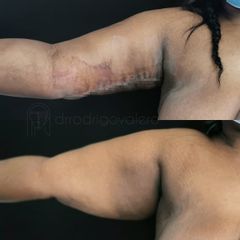 Braquioplastia - Dr. Rodrigo Valero Jarillo