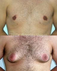 Ginecomastia - Dr. Rodrigo Valero Jarillo