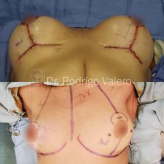 Aumento de busto - Dr. Rodrigo Valero Jarillo