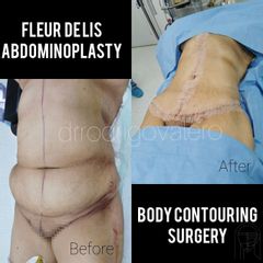 Abdominoplastia - Dr. Rodrigo Valero Jarillo