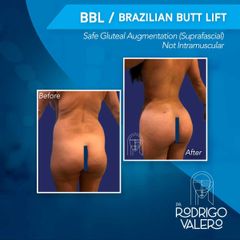 Brazilian Butt Lift - Dr. Rodrigo Valero Jarillo