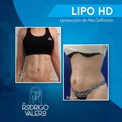 Lipo HD - Dr. Rodrigo Valero Jarillo