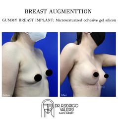 Aumento de busto - Dr. Rodrigo Valero Jarillo