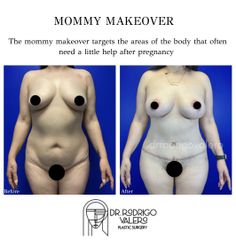 Mommy makeover - Dr. Rodrigo Valero Jarillo