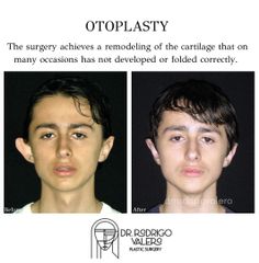 Otoplastia - Dr. Rodrigo Valero Jarillo