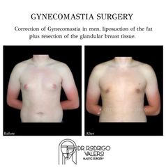 Cirugía ginecomastia - Dr. Rodrigo Valero Jarillo
