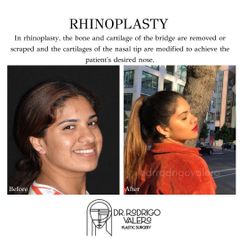 Rinoplastia- Dr Rodrigo Valero